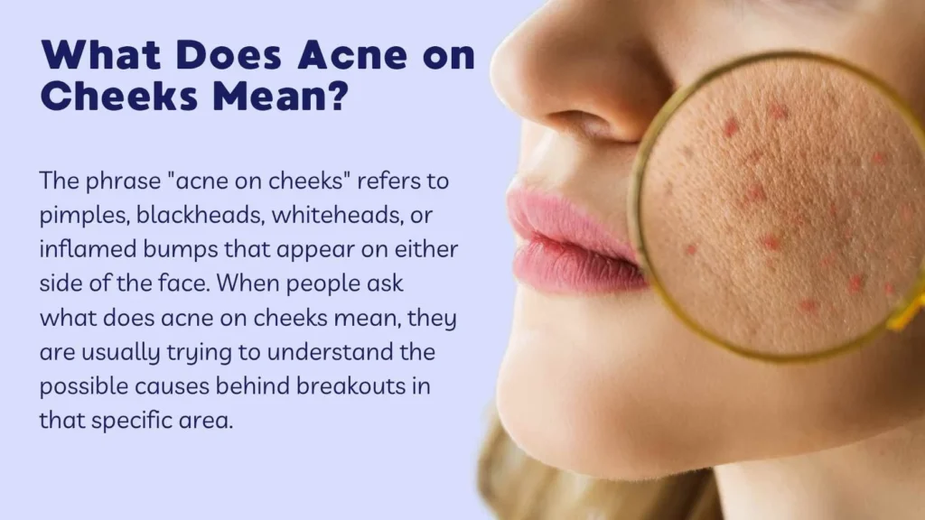 What Does Acne on Cheeks Mean?